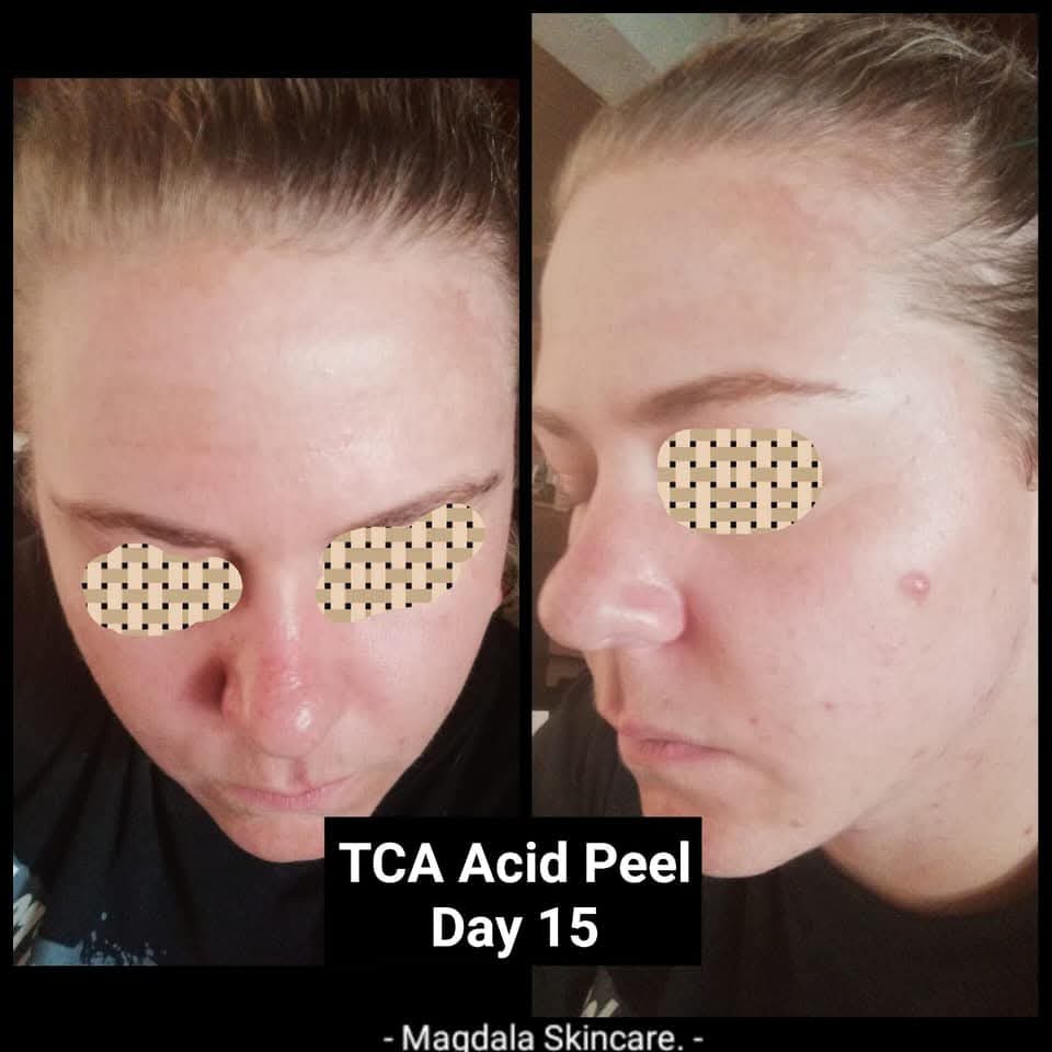 Magdala Skincare - DIY Chemical Peels