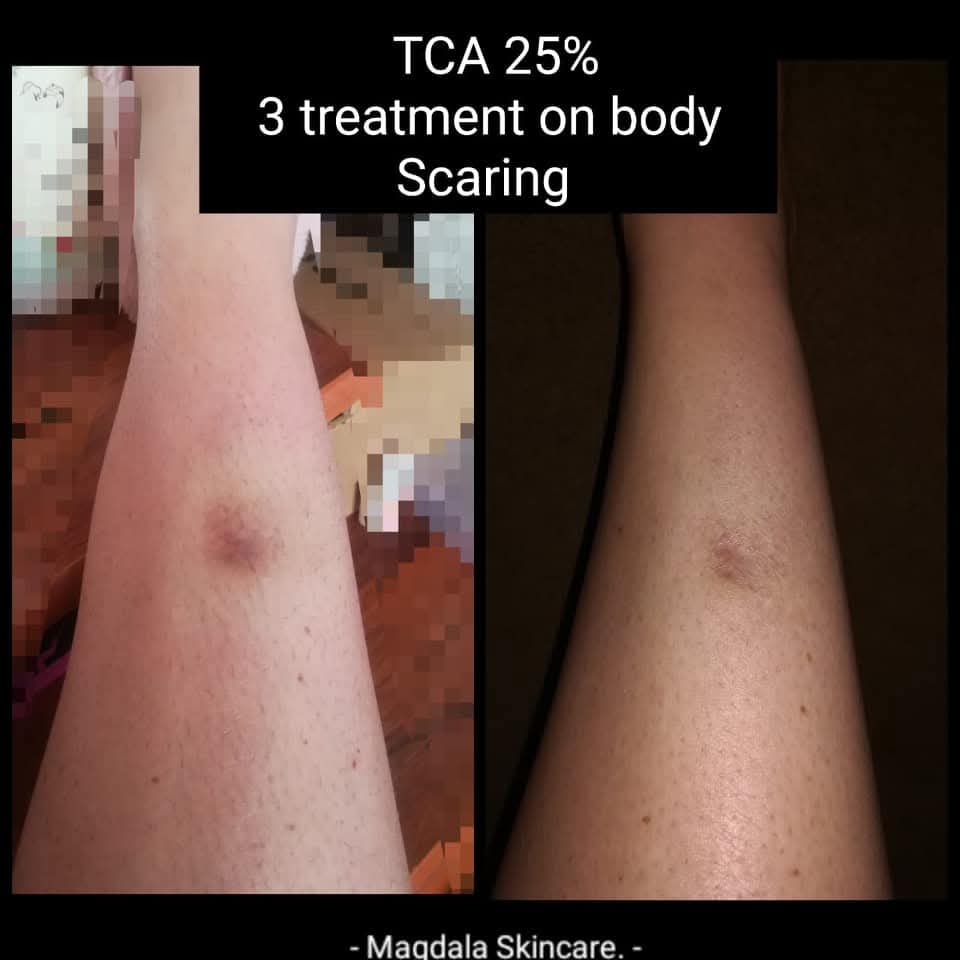 Magdala Skincare - DIY Chemical Peels