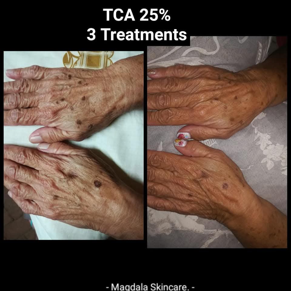 Magdala Skincare - DIY Chemical Peels